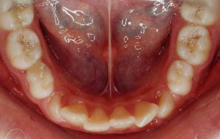 inghesuire dentara - ortodontie