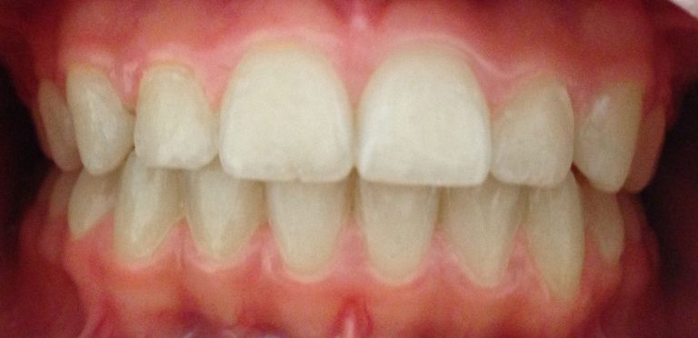 rezultat tratament aparat dentar