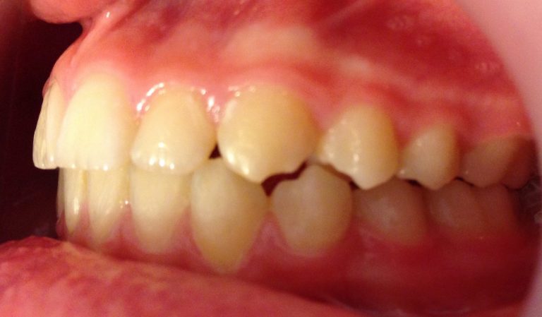 aparat dentar fix ortoclass -rezultate
