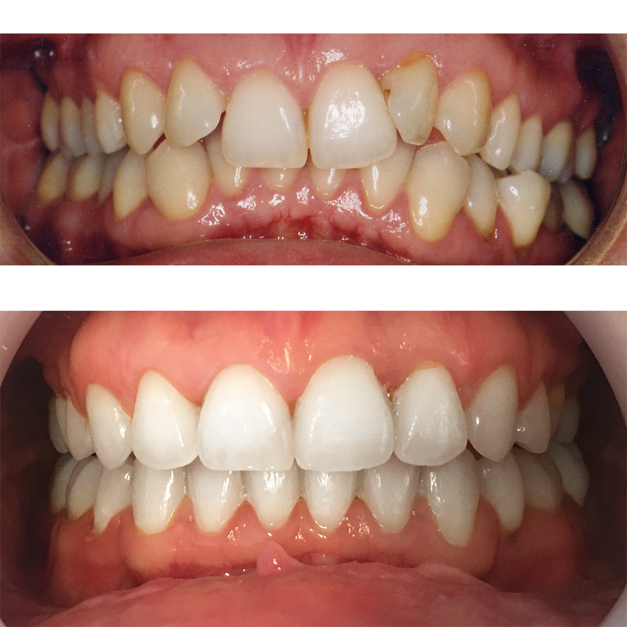 Inghesuire dentară tratată cu aparat dentar ceramic