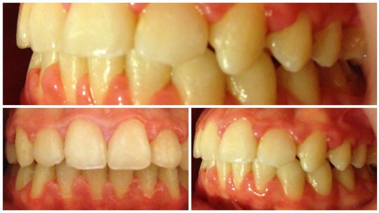 Dupa tratamentul ortodontic