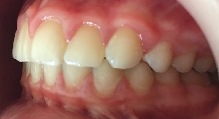 rezultat tratament ortodontic