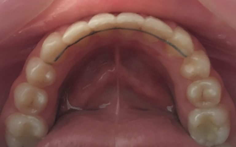 rezultat aparat dentar