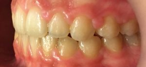 rezultat aparat dentar safir - stanga