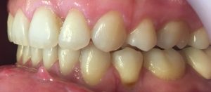 aparat dentar ceramic - inghesuire dentara 2