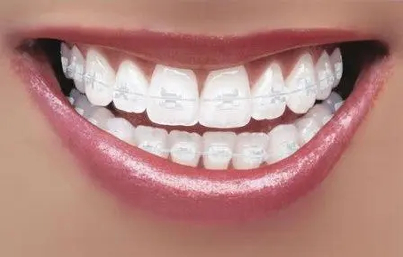 aparat dentar copii, aparat dentar adulti, aparat dentar bucuresti, preturi aparate dentare, ortoclass